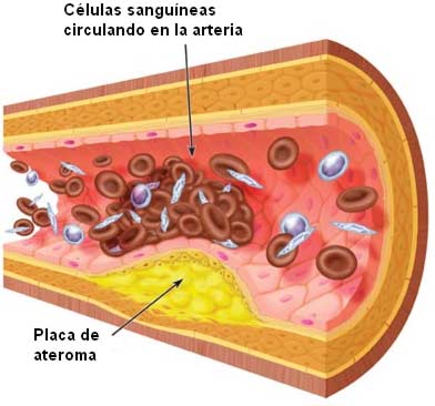 arteriosclerosis