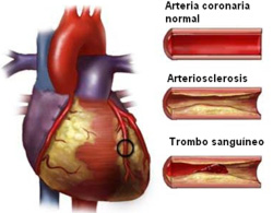 infarto arteriosclerosis